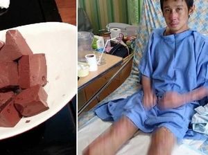 Terinfeksi Patogen Dalam Dadih Darah Babi, Pria Ini Diamputasi Kedua Kakinya Terinfeksi Patogen Dalam Dadih Darah Babi, Pria Ini Diamputasi Kedua Kakinya