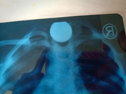 Benda Berbahaya yang Pernah Tertelan Bocah: Koin, Peluit, hingga Sikat Gigi