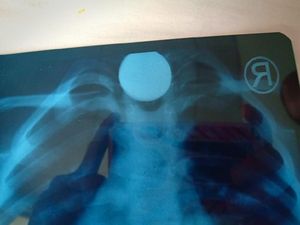 Benda Berbahaya yang Pernah Tertelan Bocah: Koin, Peluit, hingga Sikat Gigi Benda Berbahaya yang Pernah Tertelan Bocah: Koin, Peluit, hingga Sikat Gigi
