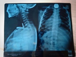 Happy Ending! Bocah 4 Tahun di Nias Telan Koin, Sudah Keluar Lewat BAB