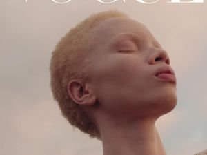 Cetak Sejarah, Ini Model Albino Pertama yang Tampil di Sampul Vogue