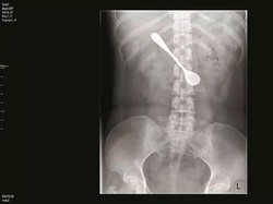 Gara-gara Tulang Ikan Nyangkut di Tenggorokan, Wanita Ini Telan Sendok!