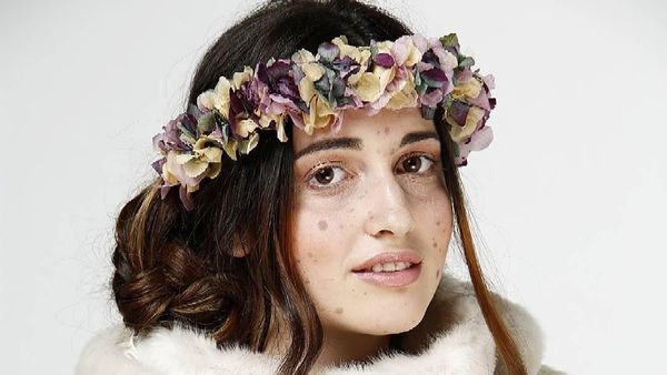 Potret Model yang Disebut Alien Hingga Monster karena Punya 500 Tanda Lahir