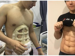 Viral Foto Pria Operasi Plastik untuk Dapat Perut Kekar Instan