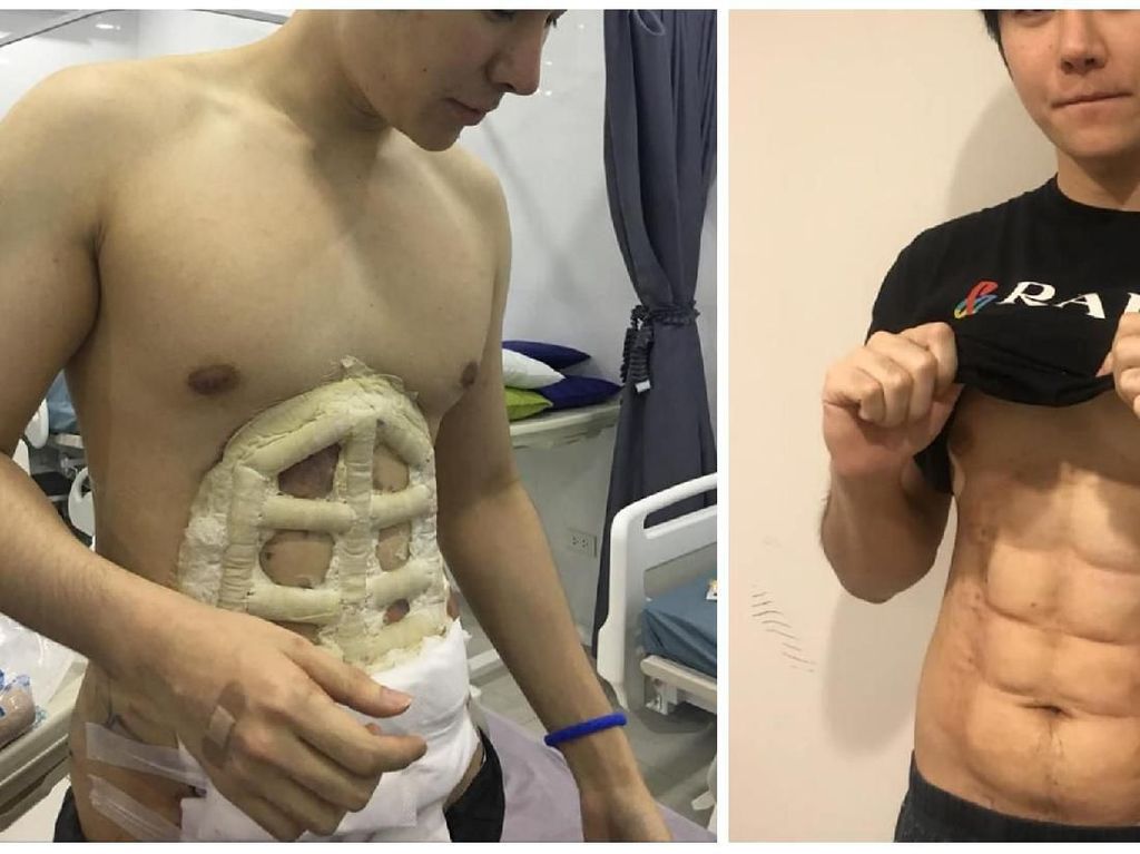 Viral Foto Pria Operasi Plastik untuk Dapat Perut Kekar Instan Viral Foto Pria Operasi Plastik untuk Dapat Perut Kekar Instan