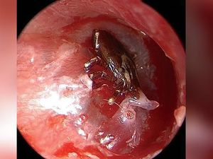 Kutu di Gendang Telinga Jadi Penyebab Telinga Tak Berhenti Berdenging