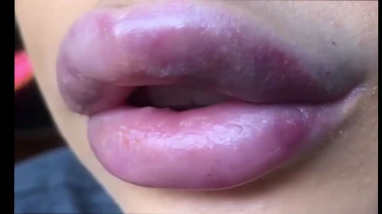 Nyatanya, Cassidy muncul dengan cerita tentang filler bibirnya yang gagal. Setelah satu tahun tidak membuat video di Youtube, Cassidy menunjukkan kondisinya saat ini.  Foto: dok. Instagram