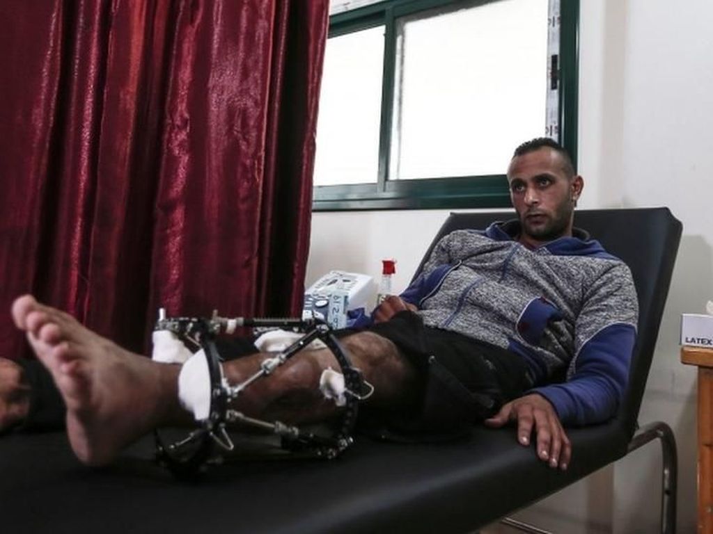 Hampir 2.000 Warga Palestina yang Tertembak Militer Israel Harus Diamputasi Hampir 2.000 Warga Palestina yang Tertembak Militer Israel Harus Diamputasi