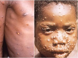 Cacar Monyet: Gejala, Penyebab, dan Pengobatan