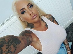 Gara-gara Filler, Bibir Wanita Ini Jontor dan Hampir Tewas