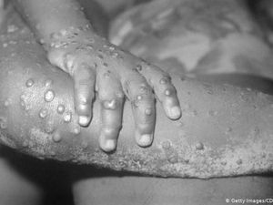 Catat! Gejala Virus Cacar Monyet, Fase Awal hingga Infeksius Catat! Gejala Virus Cacar Monyet, Fase Awal hingga Infeksius