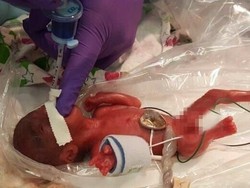 Lahir Seberat Apel, Bayi Terkecil Sedunia Berhasil Bertahan Hidup
