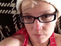 Pengalaman Ngeri Wanita yang 86 Kali Operasi Demi Lawan Kanker Kulit