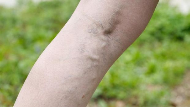 Penyebab dan Gejala Varises Saat Hamil yang Perlu Bunda Tahu