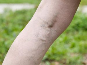 Muncul Urat Biru di Belakang Lutut dan Paha, Gejala Varises? Begini Kata Dokter Muncul Urat Biru di Belakang Lutut dan Paha, Gejala Varises? Begini Kata Dokter