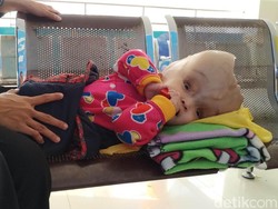 Dipantau RSHS, Bayi Tanpa Tempurung Kepala Kontrol Sebulan Sekali