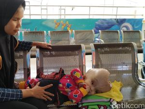 Malangnya Bayi Saira, Penderita Hidrosefalus Tanpa Tempurung Kepala Malangnya Bayi Saira, Penderita Hidrosefalus Tanpa Tempurung Kepala