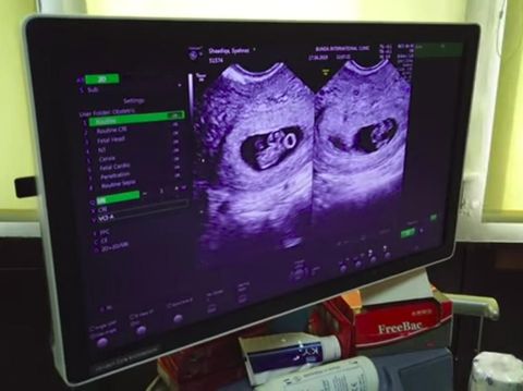 4 Hal Penting Saat Hamil Anak Kembar Seperti Syahnaz Sadiqa