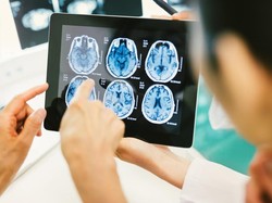 Tumor Otak Kini Bisa Dideteksi Pakai Artificial Intelligence