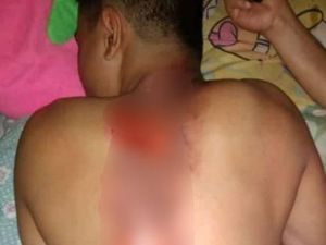Viral Siswa Disiram Air Keras di Pacitan, Polisi Tunggu Laporan