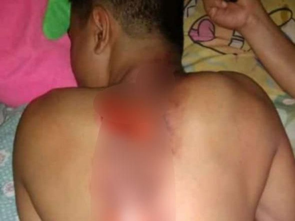 Viral Siswa Disiram Air Keras di Pacitan, Polisi Tunggu Laporan Viral Siswa Disiram Air Keras di Pacitan, Polisi Tunggu Laporan