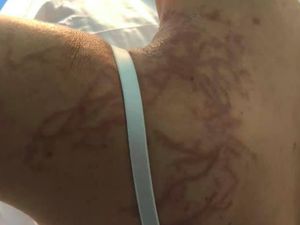 Tato Petir Unik Muncul di Tubuh Wanita Ini Usai Disengat Hewan Laut