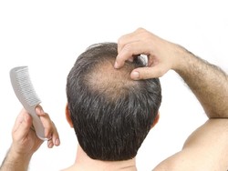 Agar Rambut Tak Cepat Botak Rajinlah Konsumsi 5 Buah Enak Ini