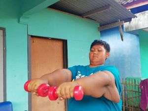 Kerja Keras Tim Dokter Angkat Gelambir Kulit Aria Bocah Tergemuk Kerja Keras Tim Dokter Angkat Gelambir Kulit Aria Bocah Tergemuk