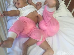 Bayi Kembar Siam Adam-Malik Segera Dioperasi Tim Dokter RSUP Medan Bayi Kembar Siam Adam-Malik Segera Dioperasi Tim Dokter RSUP Medan