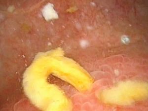 Ususnya Bocor, Feses Wanita Ini Bisa Keluar Lewat Kencing