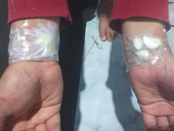Viral Bawang Putih Ditempel di Tangan Obati Sakit Gigi, Ini Kata Dokter