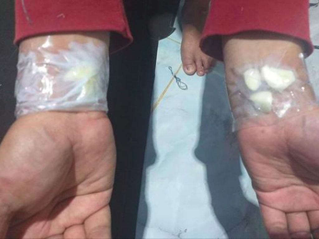 Viral Bawang Putih Ditempel di Tangan Obati Sakit Gigi, Ini Kata Dokter Viral Bawang Putih Ditempel di Tangan Obati Sakit Gigi, Ini Kata Dokter