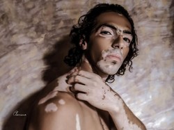 Kisah Hassan yang Dulu Di-bully Karena Kulit Belang, Kini Jadi Model Mendunia