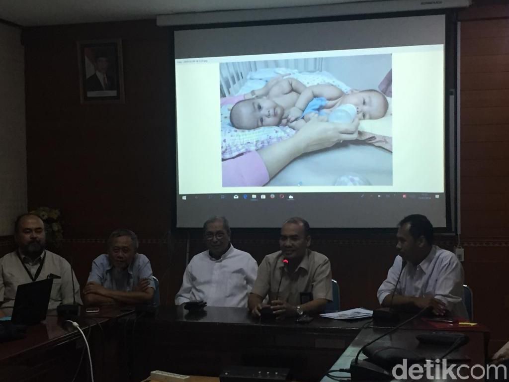 Bayi Kembar Siam Adam-Malik Jalani Operasi Pemisahan 23 Juli