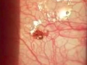 Terganggu Titik Hitam Mengganjal, Ternyata Ada Kutu di Bola Mata Pria Ini