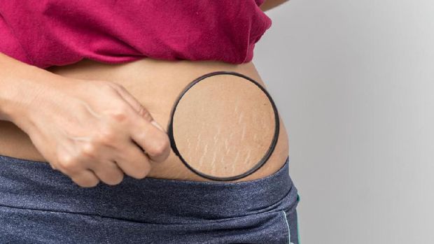 Women Show off the belly after birth. Stretch Marks on white background