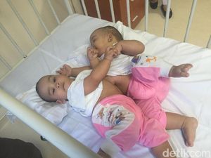 Kembar Siam Adam Malik Jalani Operasi Pemisahan Hari Ini