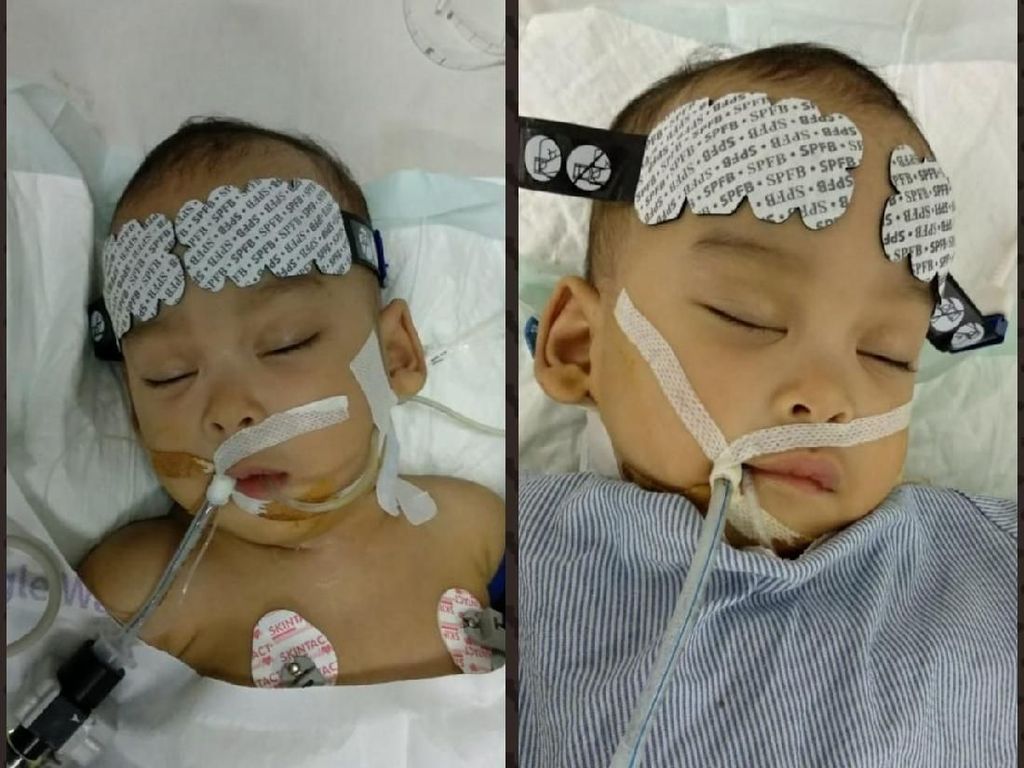 Operasi Lancar, Bayi Kembar Siam Adam-Malik Berhasil Dipisahkan