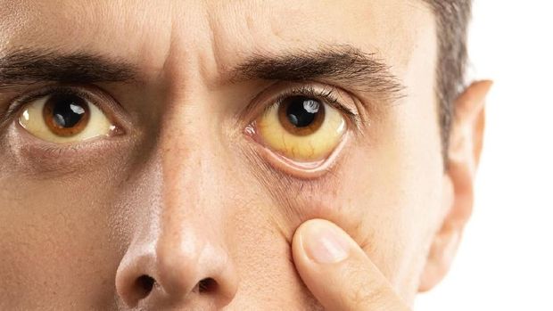 Man checking his health condition. Yellowish eyes is sign of problems with liver, viral infection or other disease.
