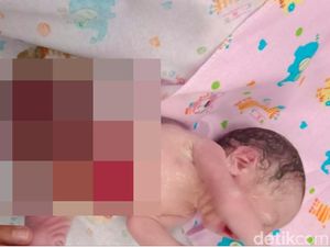 Terlahir dengan Usus di Luar Tubuh, Bayi Arjun Dirawat Intensif di Medan Terlahir dengan Usus di Luar Tubuh, Bayi Arjun Dirawat Intensif di Medan