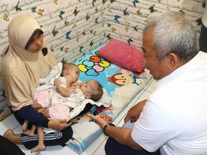 Wali Kota Bekasi Jamin Biaya Operasi Bayi Kembar Dempet Rahman-Rahim Wali Kota Bekasi Jamin Biaya Operasi Bayi Kembar Dempet Rahman-Rahim