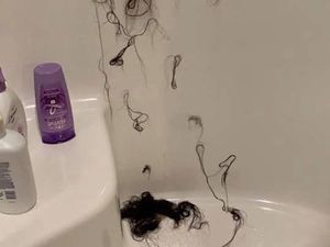 Wanita Ini Alami Kerontokan Rambut hingga Botak karena Kondisioner