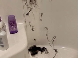 Wanita Ini Alami Kerontokan Rambut hingga Botak karena Kondisioner