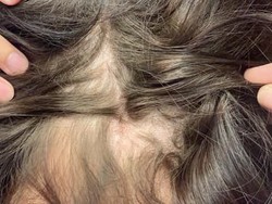 Botak Bukan Cuma Masalah Pria, Wanita Juga Bisa Kena