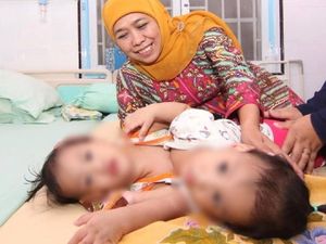 Khofifah Optimistis Operasi Kembar Siam di RSU dr Soetomo Berhasil