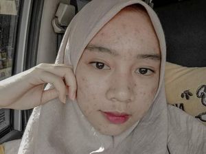 Cerita Inspiratif Mahasiswi UPI, Viral karena Pamer Foto Jerawatan di Medsos