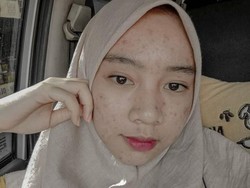 Cerita Inspiratif Mahasiswi UPI, Viral karena Pamer Foto Jerawatan di Medsos