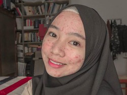 Viral Dipuji Netizen, Hijabers Cianjur yang Bangga Pamer Wajah Berjerawat