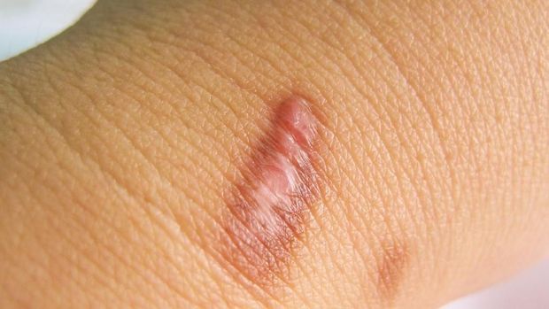 ilustrasi keloid