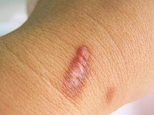 Keloid Adalah: Arti, Gejala, Penyebab, hingga Cara Mengobatinya Keloid Adalah: Arti, Gejala, Penyebab, hingga Cara Mengobatinya